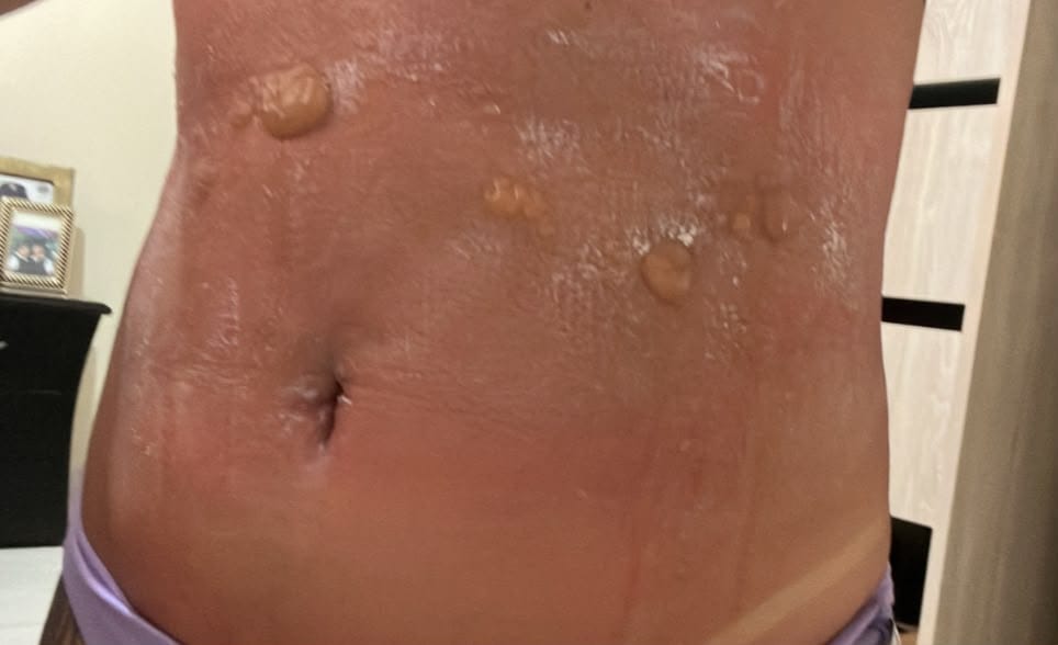 Denuncian presuntas irregularidades en Spa de Popayán tras bronceado estético que habría causado graves quemaduras