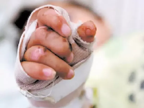 Niña de doce años terminó con la mano derecha fracturada tras manipular un elemento pirotécnico