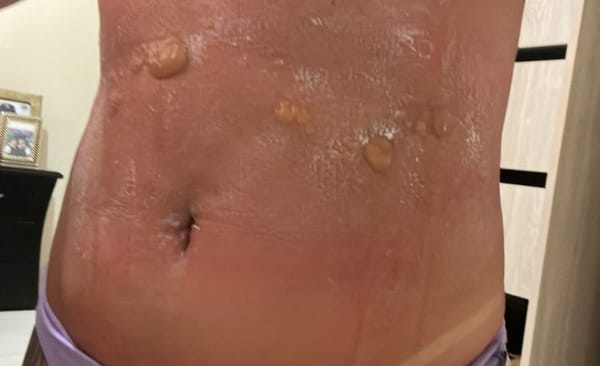 Denuncian presuntas irregularidades en Spa de Popayán tras bronceado estético que habría causado graves quemaduras